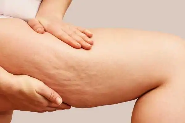Image of woman showing leg with cellulite Kington