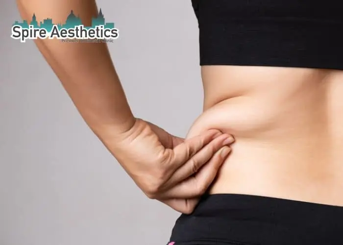 Image of woman pinching fat on their hips Kington. Fat Freezing treatment