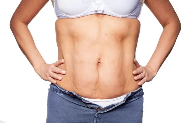 sagging skin on woman's stomach after weight loss injections Kington